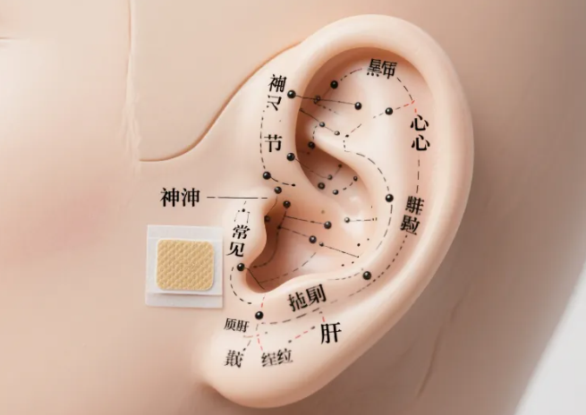 义诊福利｜小巧耳穴贴，轻松伴日常