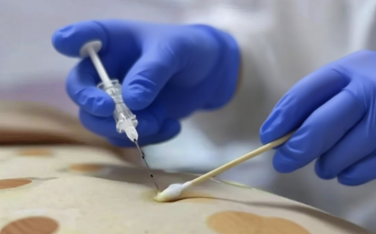 身材告急?中式埋线帮你轻松享“瘦”不费力!